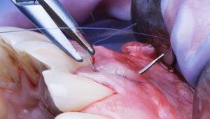 Chỉ khâu nha khoa là gì?