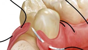 Tổng Hợp Các Loại Chỉ Khâu Nha Khoa Phổ Biến Hiện Nay